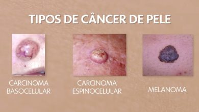 Novo tratamento contra o câncer de pele pode entrar no SUS